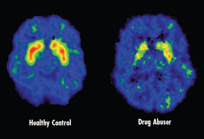 What are the effects of alcohol and drugs on the brain?